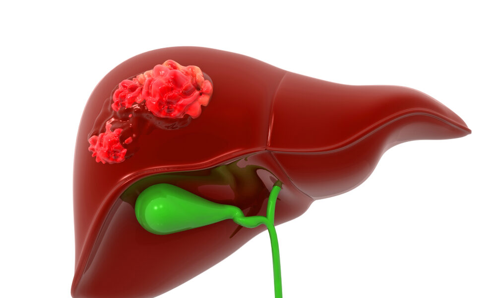 Representação de um Figado com tumor de klatskin